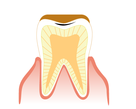 エナメル質層内の虫歯