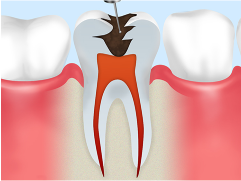 虫歯の除去